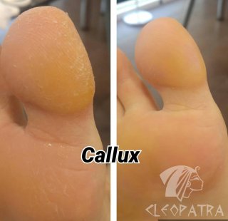 Callux lábápolás